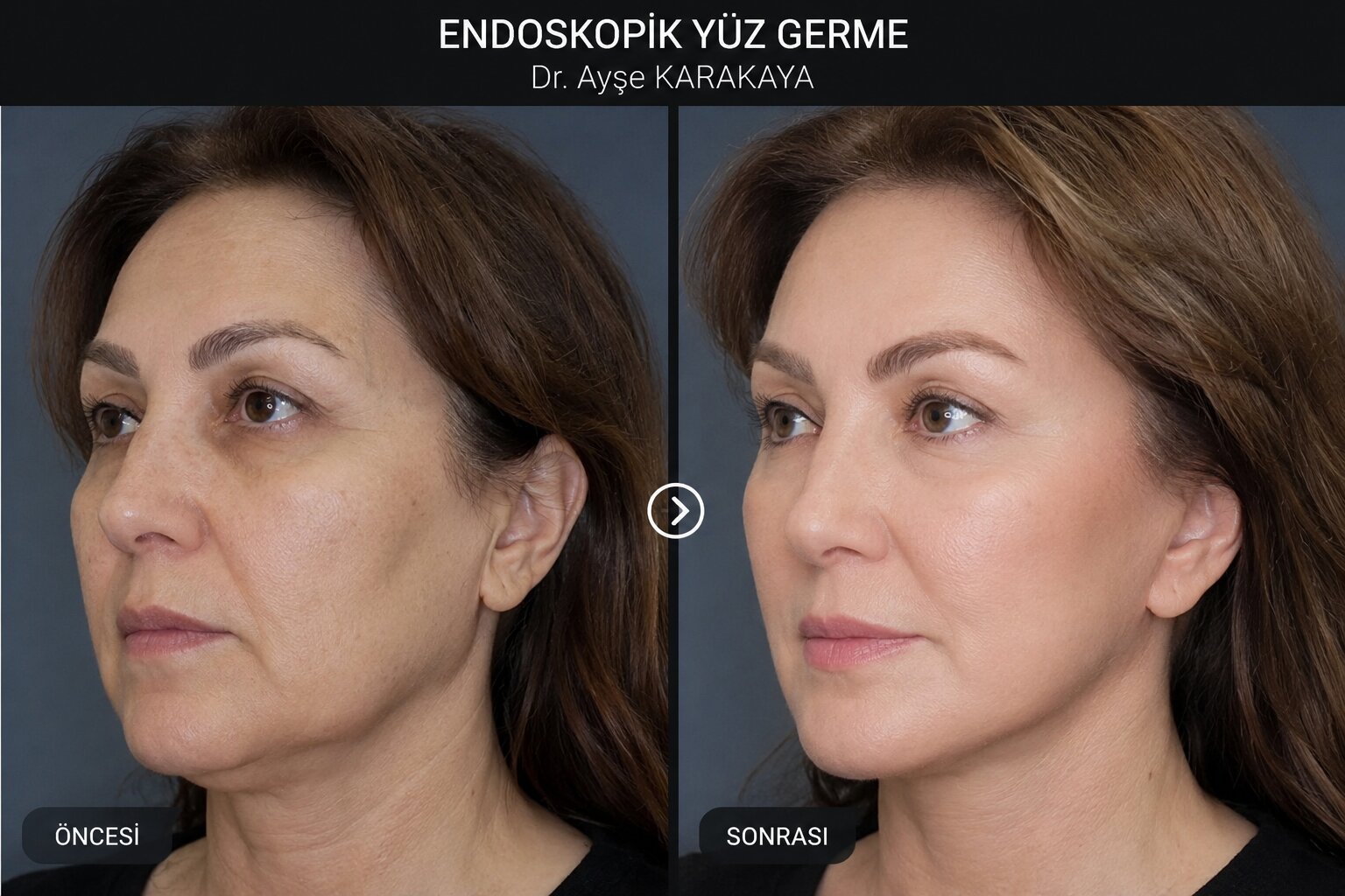 Endoskopik Yüz Germe